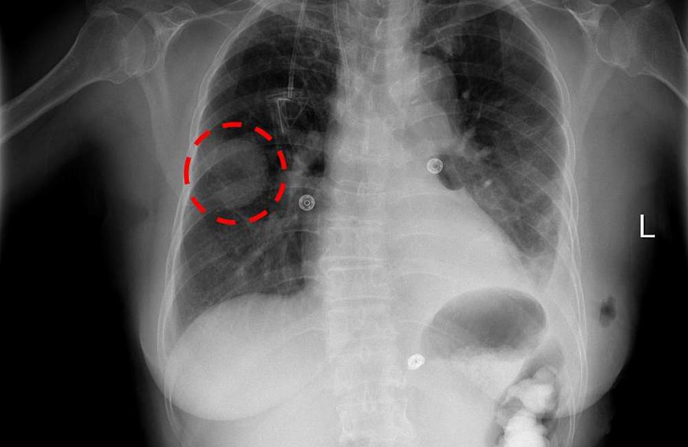 ChestXRay14 image